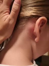 „Crvenilo iza ušiju kod devojčice kao simptom ekcema – primer kako izgleda ekcem kod dece“