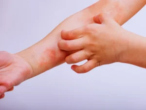 "Dečija ruka sa ekcemom koju dete češe – vidljivo crvenilo i iritacija kože"